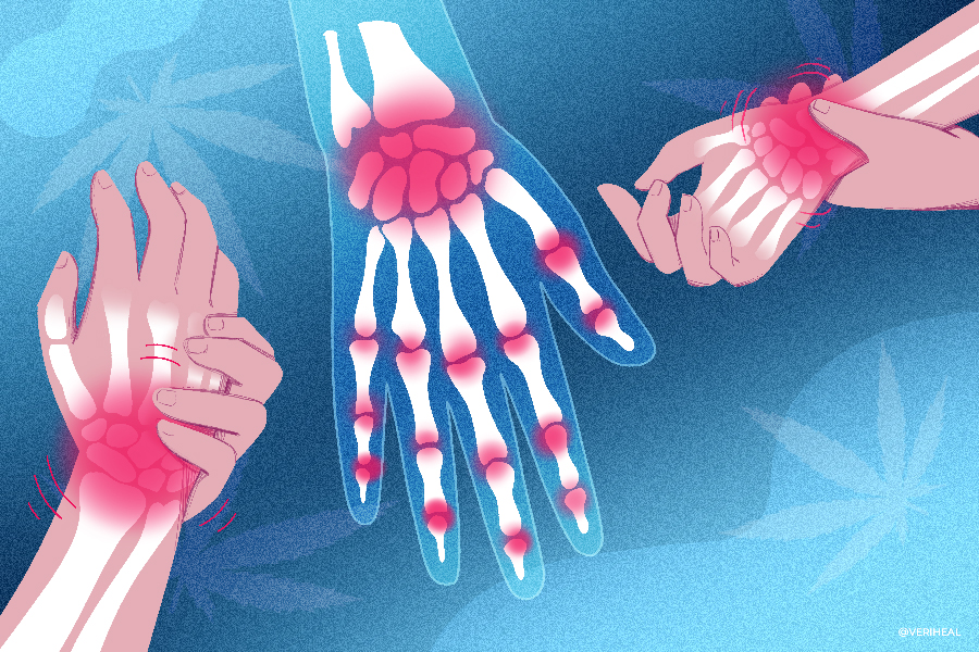 Arthritis