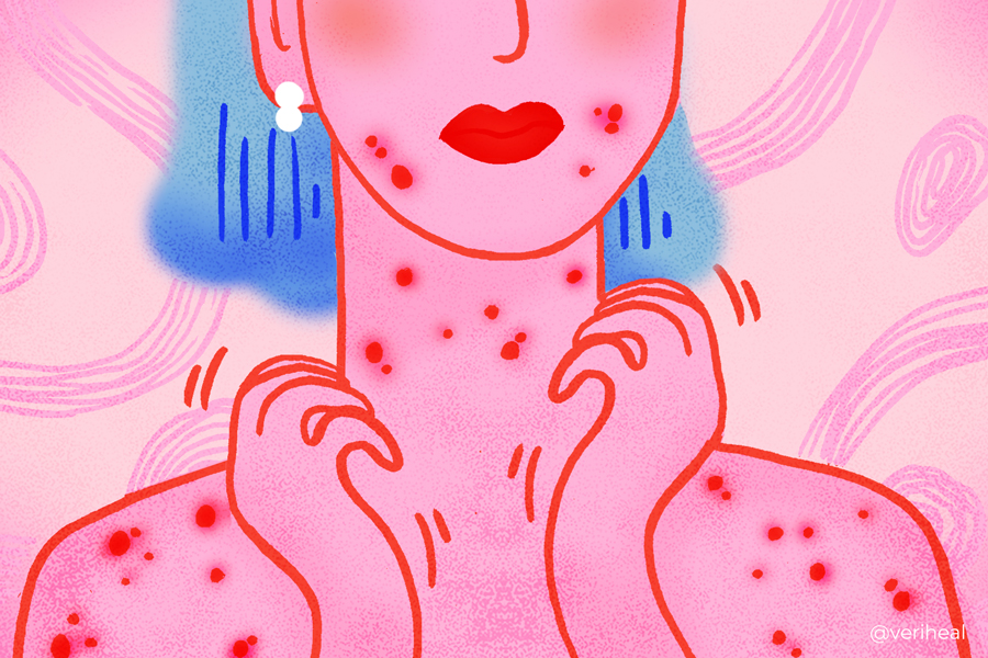 chicken pox