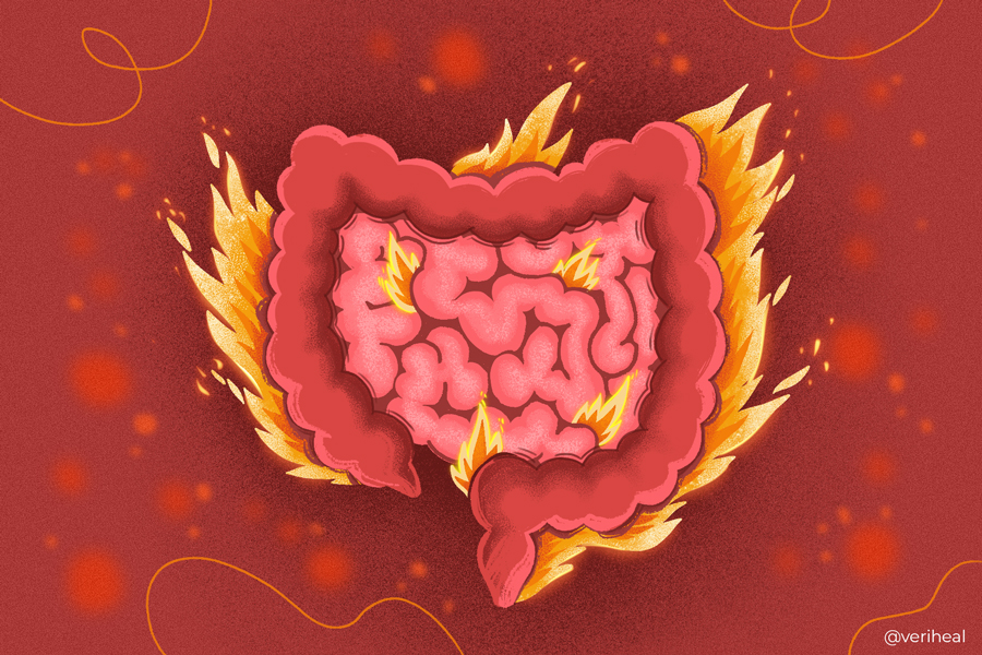Crohn's