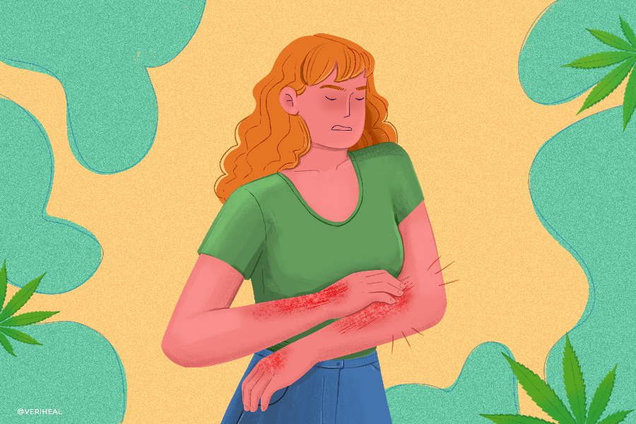 Eczema