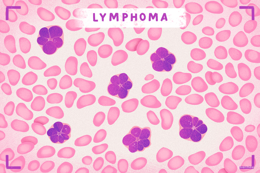 Lymphoma