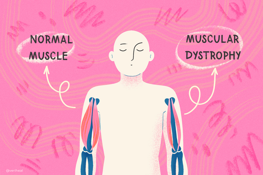 Muscular_Dystrophy