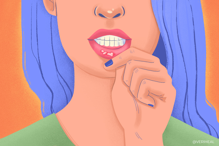 Oral Ulcers