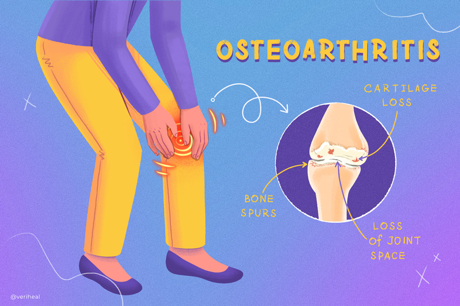 Osteoarthritis
