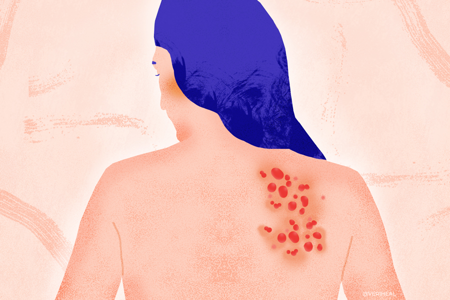 Postherpetic Neuralgia
