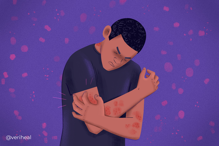 Psoriasis
