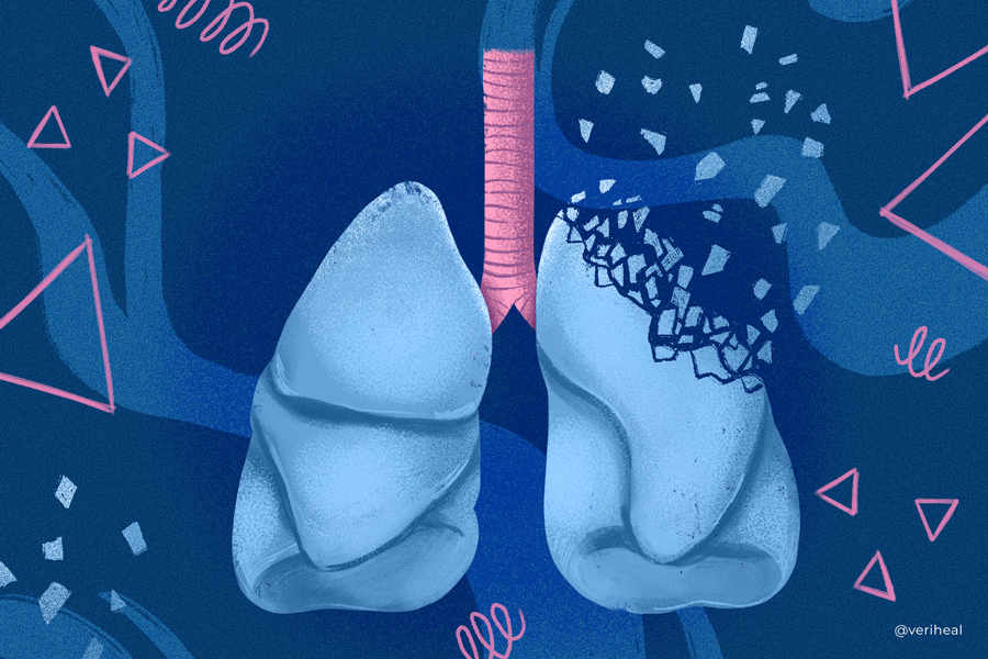 Pulmonary Fibrosis