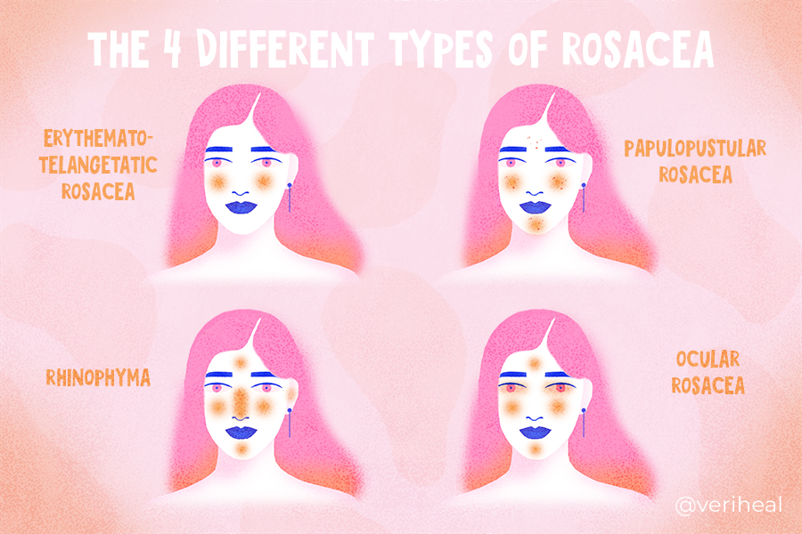 Rosacea