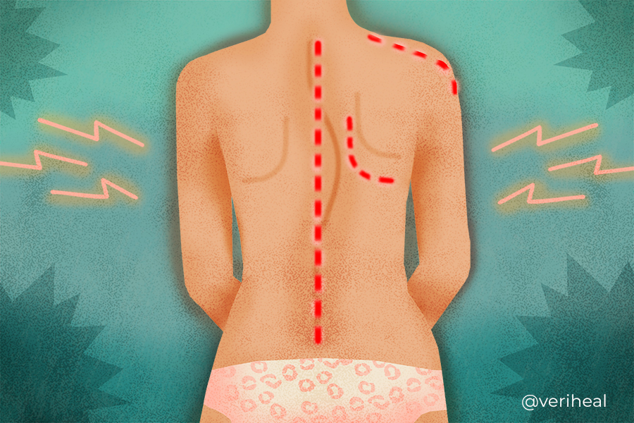 Scoliosis