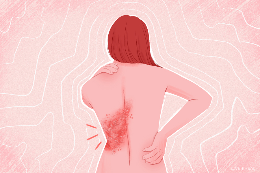 Shingles