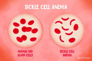 Sickle Cell
