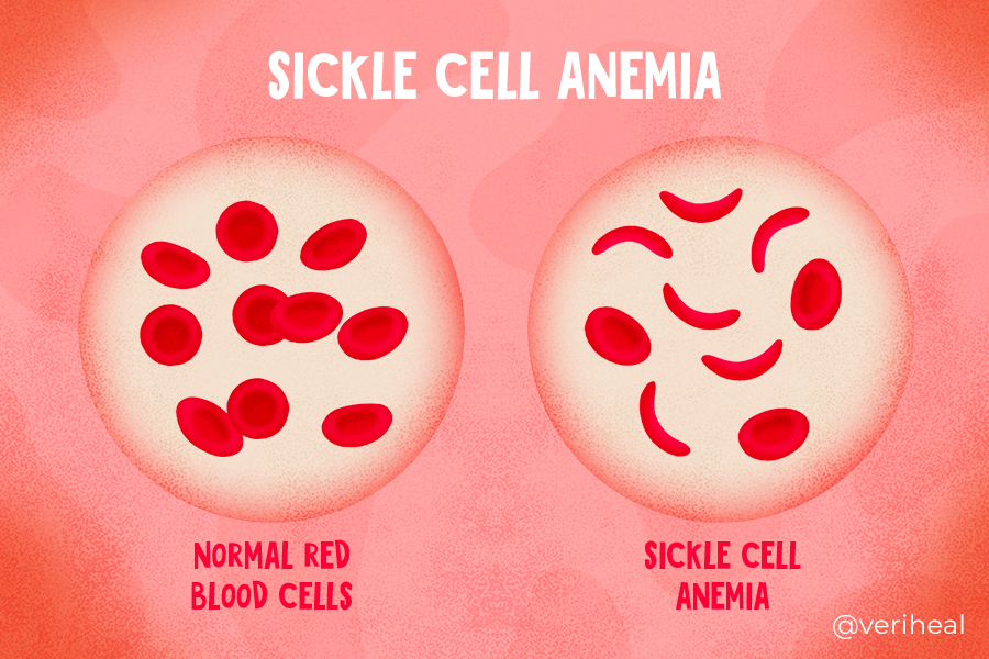 Sickle Cell