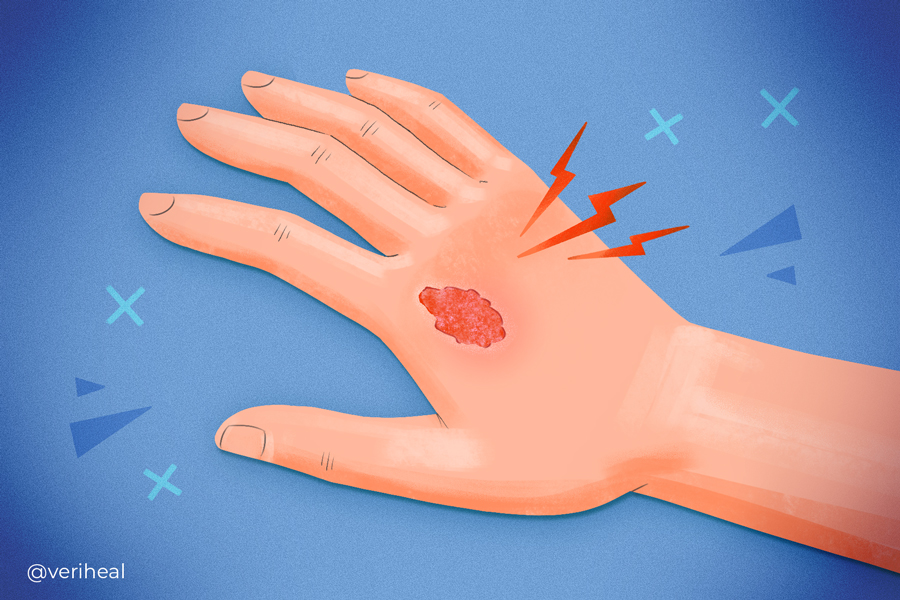 Skin_Ulcers